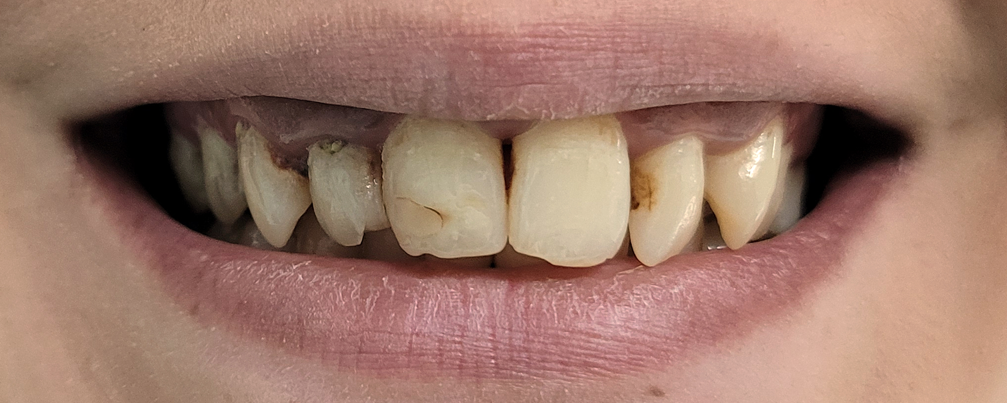 Coroane din ceramica pe zirconiu si implanturi dentare - situatia initiala