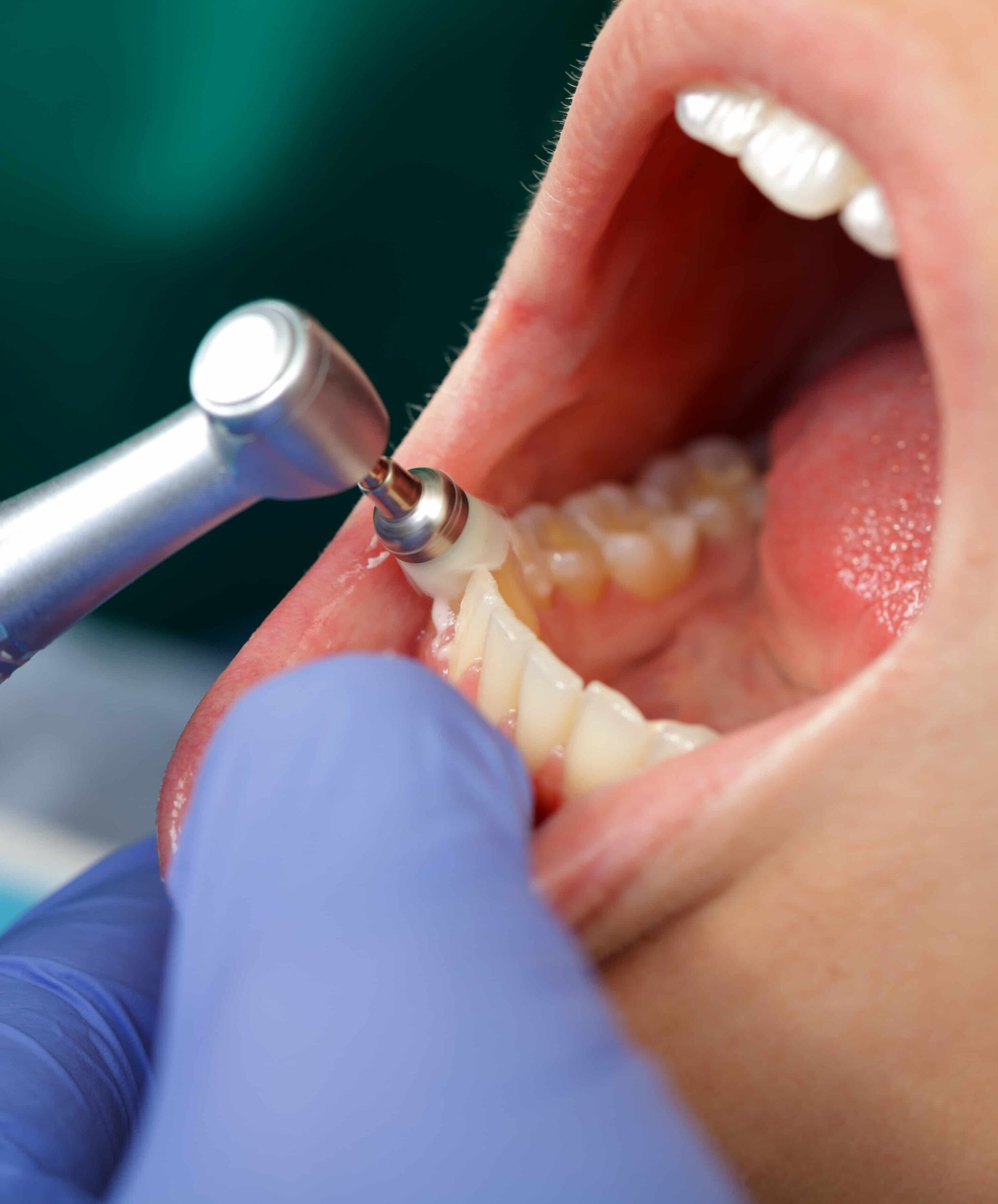 Profilaxia dentară - cabinet stomatologic Smile Architects