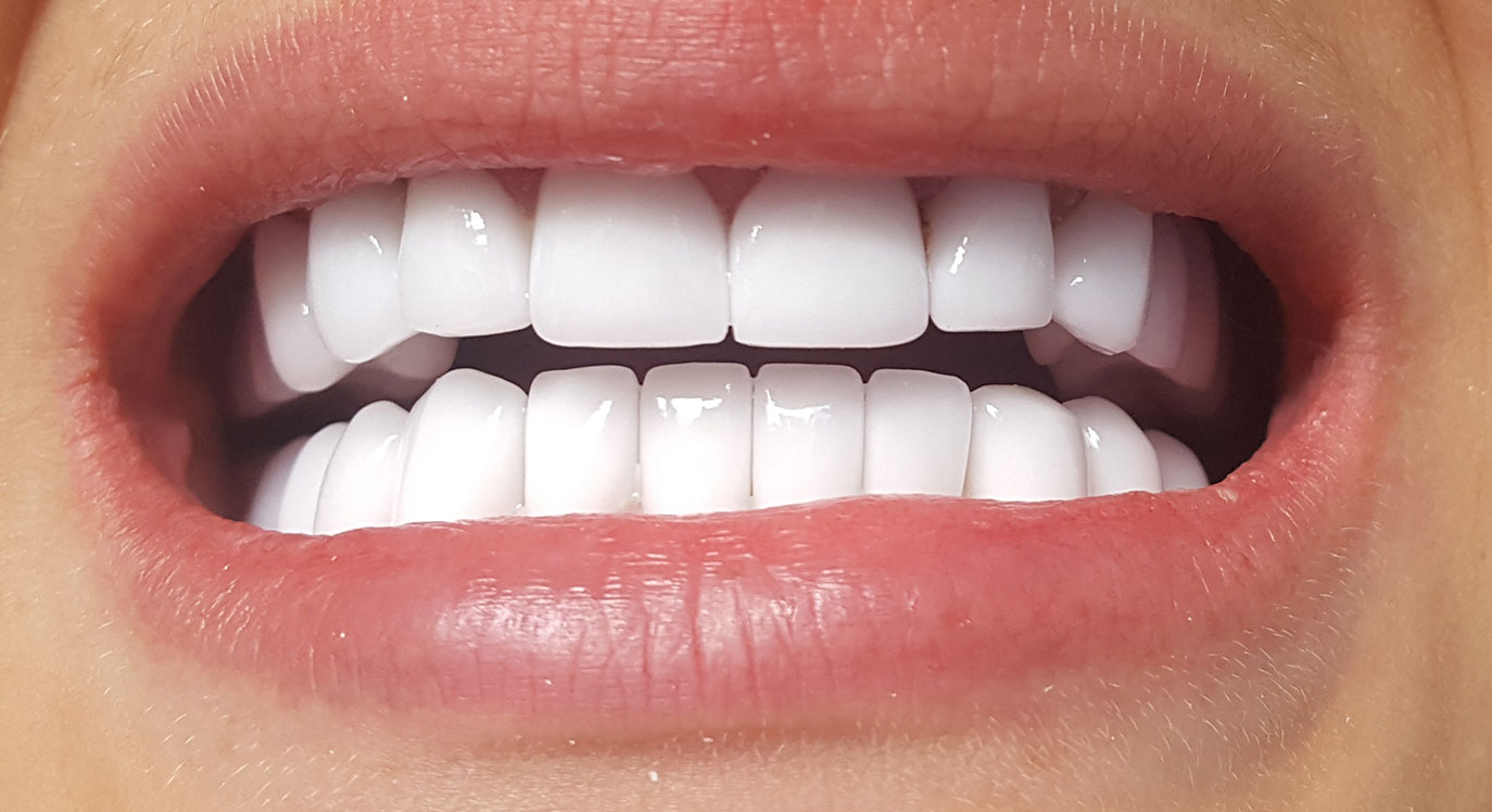 Coroane de ceramica pe suport de zirconiu - situatia finala