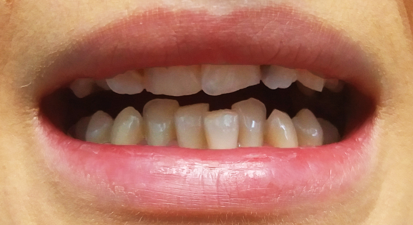 Coroane de ceramica pe suport de zirconiu - situatia initiala