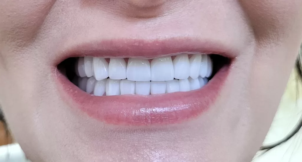ceramica pe zirconiu, final - Smile Architects, cabinet stomatologic