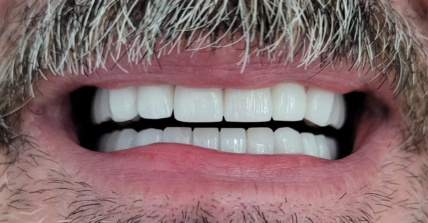 Coroane zirconiu multilayer - situatia finala