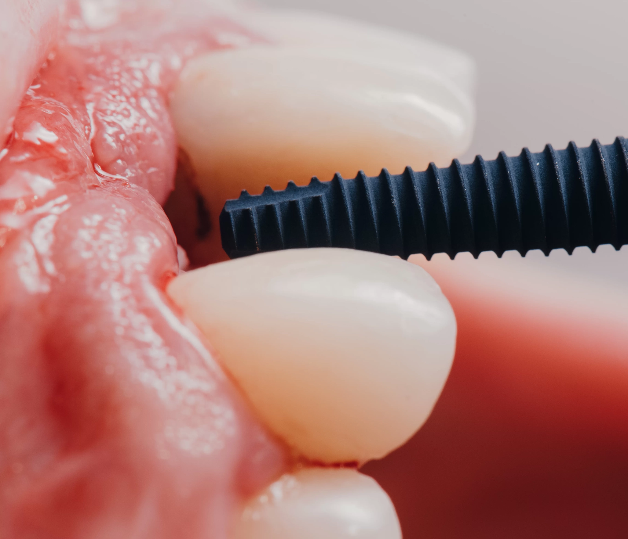 Implant dentar - cabinet stomatologic