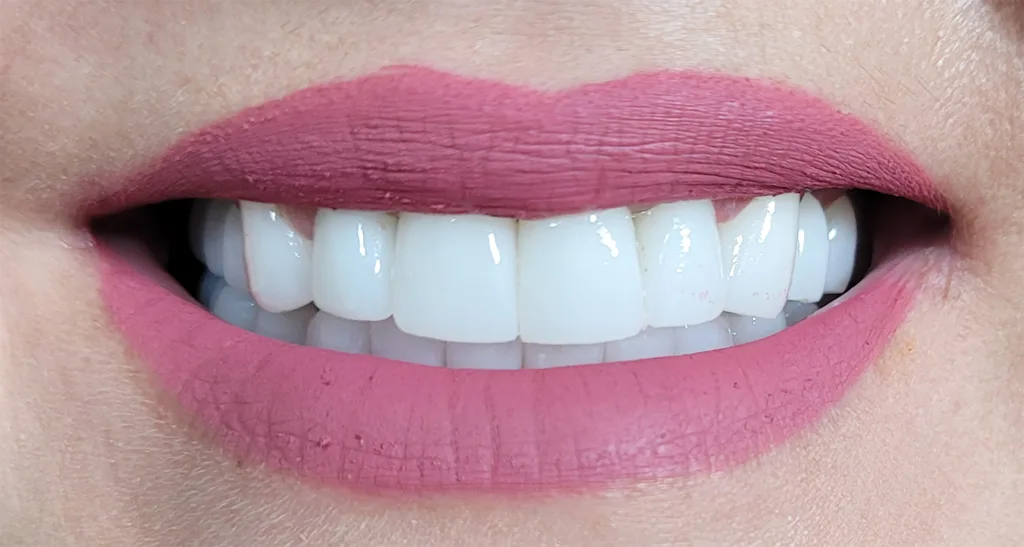 Coroane individuale zirconiu multilayer final