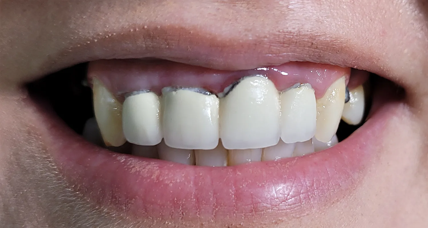 Coroane individuale zirconiu multilayer - situatia initiala